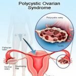 An Unconventional Approach to PCOS (polycystic ovarian syndrome)